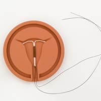 Sport nach Spirale einsetzen Sport nach Spirale einsetzen