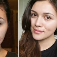 anna-maria-damm-akne-557-1953562.jpg anna-maria-damm-akne-557-1953562.jpg