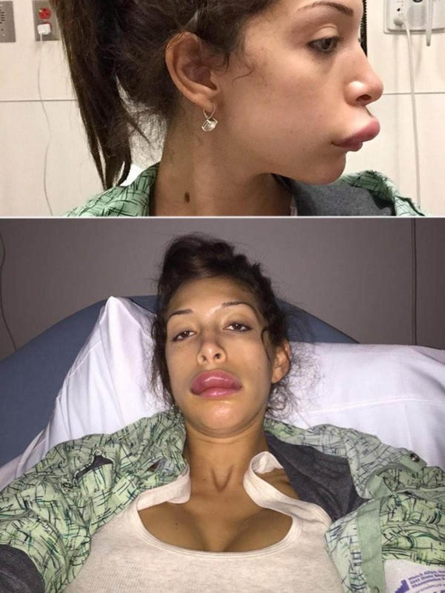 Farrah Abraham: Lippen-Implantate