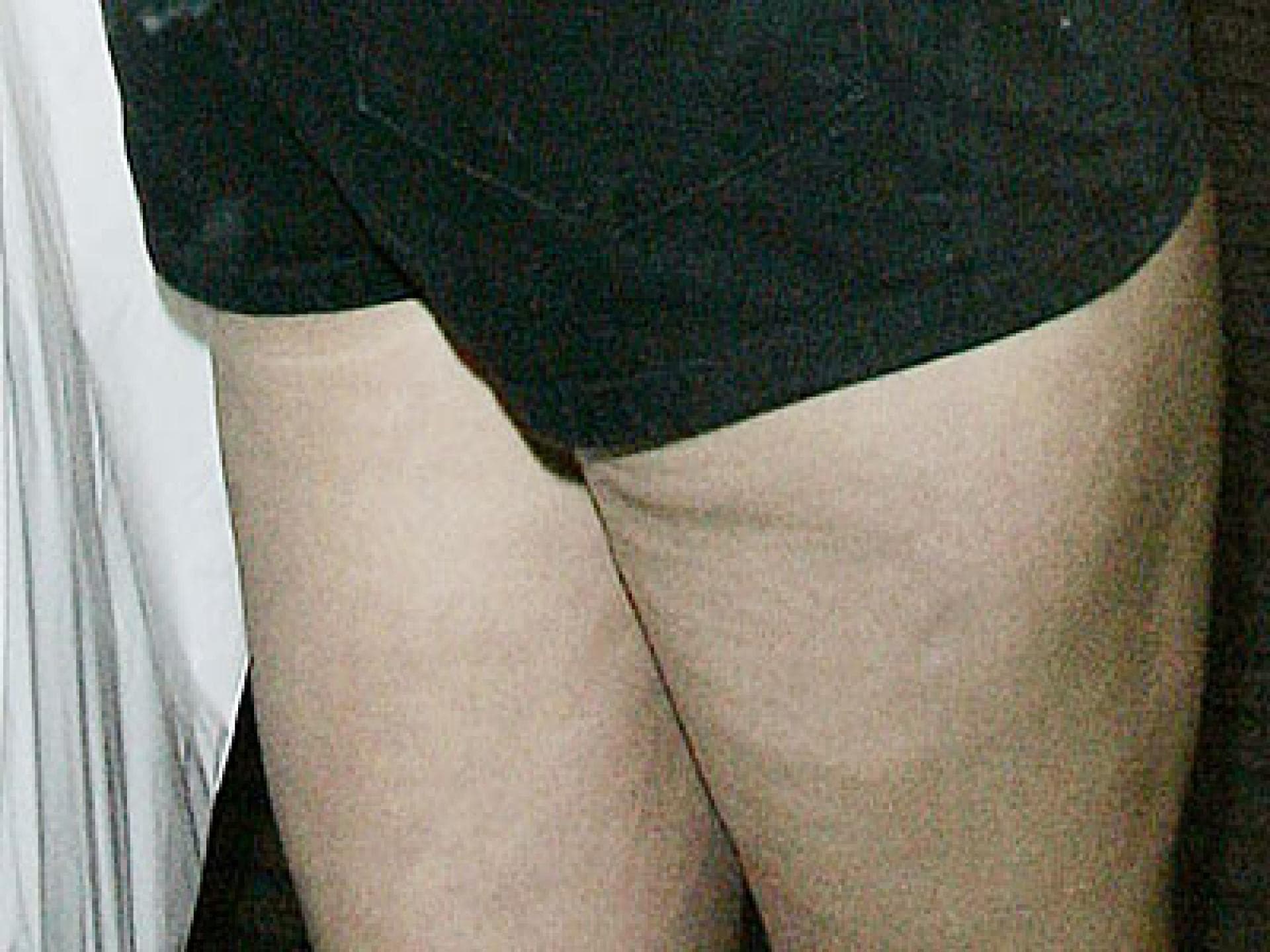 Dellen bei Kate Moss