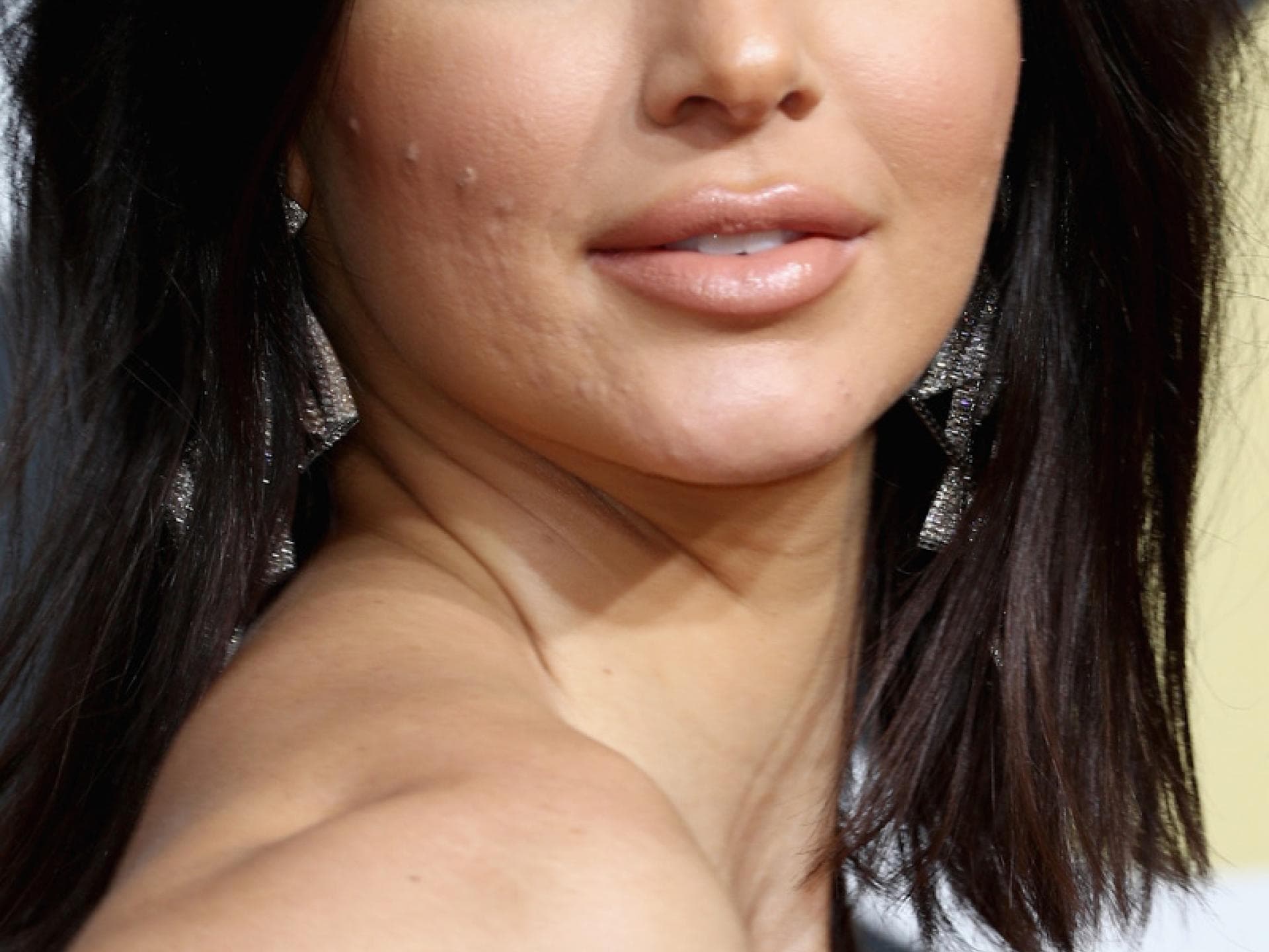 Kendall Jenner: Akne Kendall Jenner: Akne