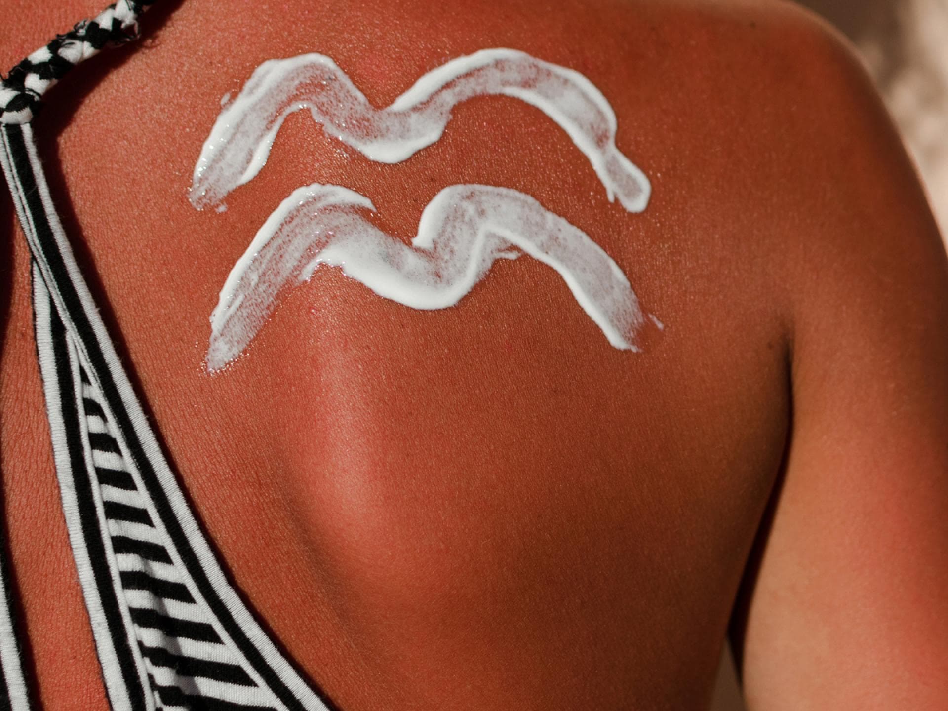 …ich einen leichten Sonnenbrand habe? …ich einen leichten Sonnenbrand habe?